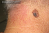 Melanoma